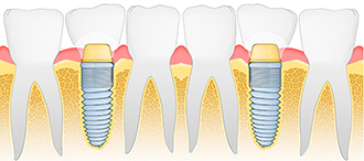 Joffe-Dental-implants