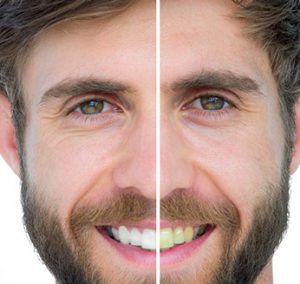 teethwhitening